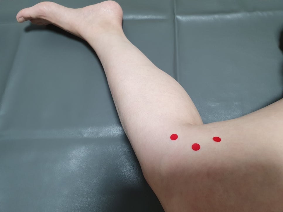 퇴행성 무릎 골관절염005