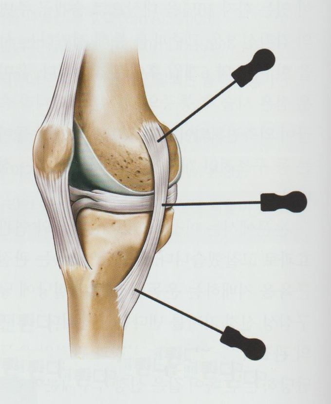 퇴행성 무릎 골관절염006