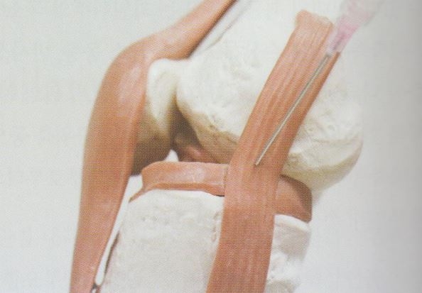 퇴행성 무릎 골관절염007