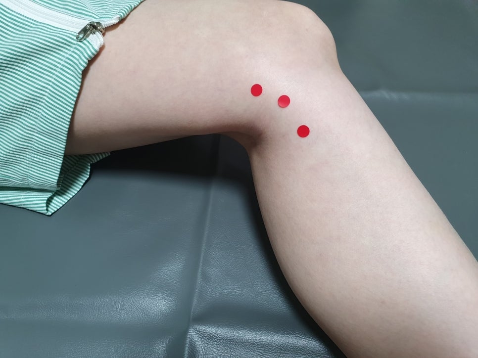 퇴행성 무릎 골관절염008