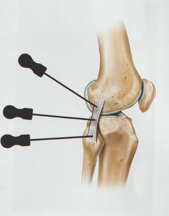 퇴행성 무릎 골관절염009