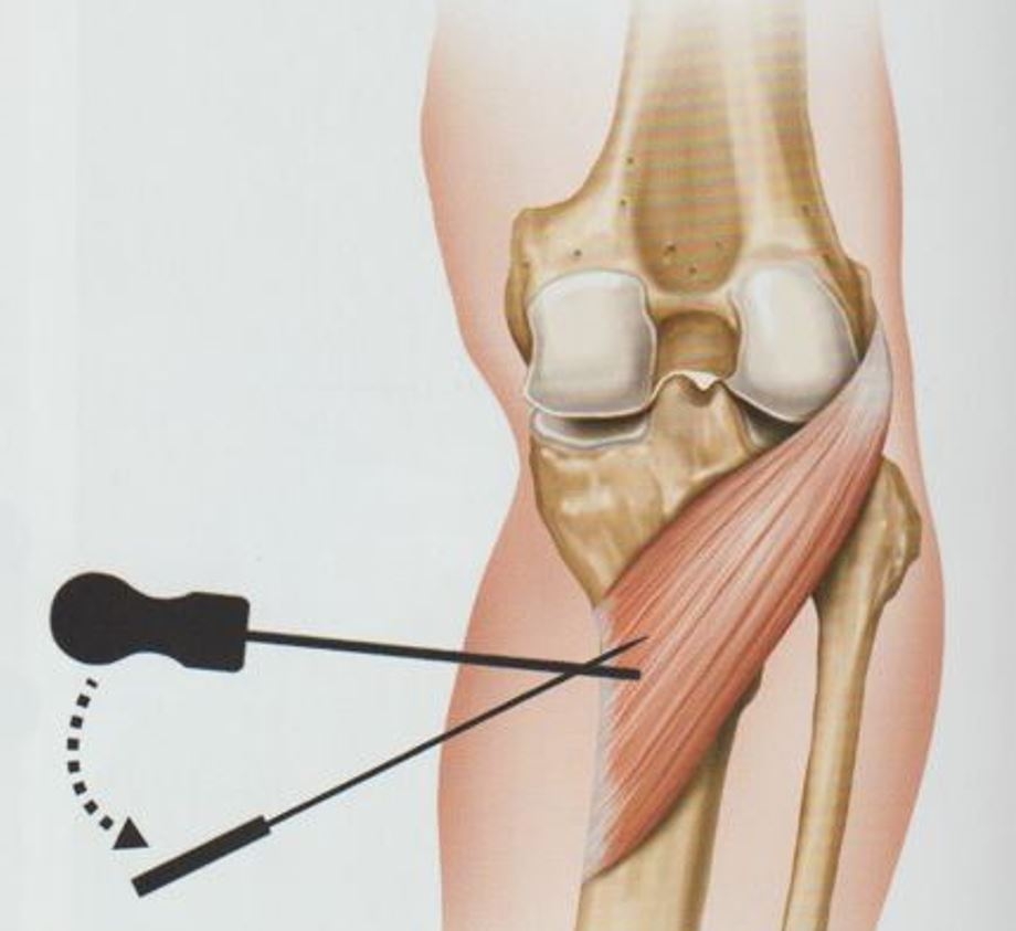 퇴행성 무릎 골관절염010