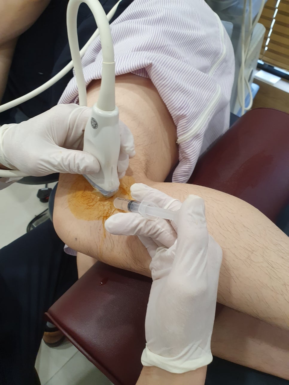 퇴행성 무릎 골관절염014