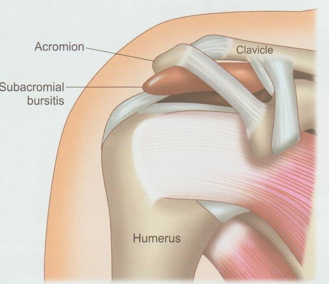 회전근개증후군02