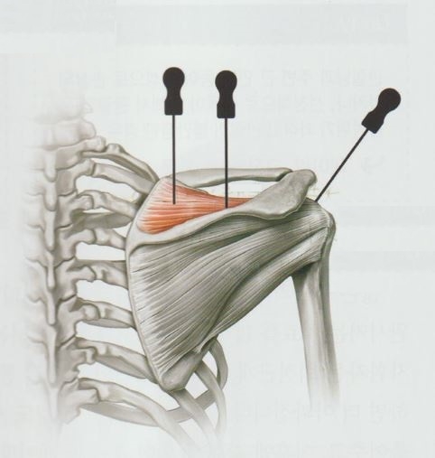 회전근개증후군03