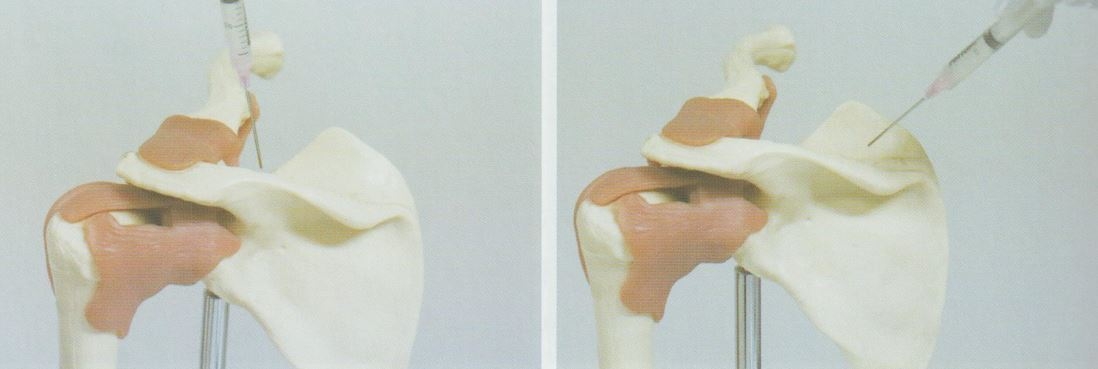 회전근개증후군04