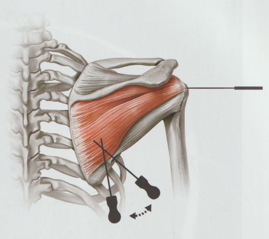 회전근개증후군05