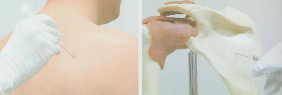 회전근개증후군06