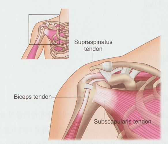 회전근개증후군07