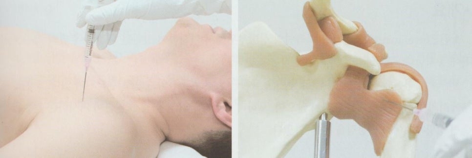 회전근개증후군08