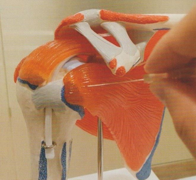 회전근개증후군09