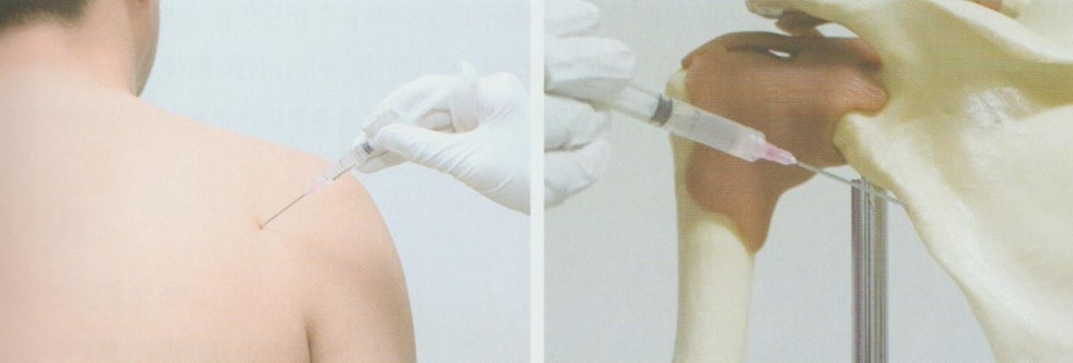 회전근개증후군11